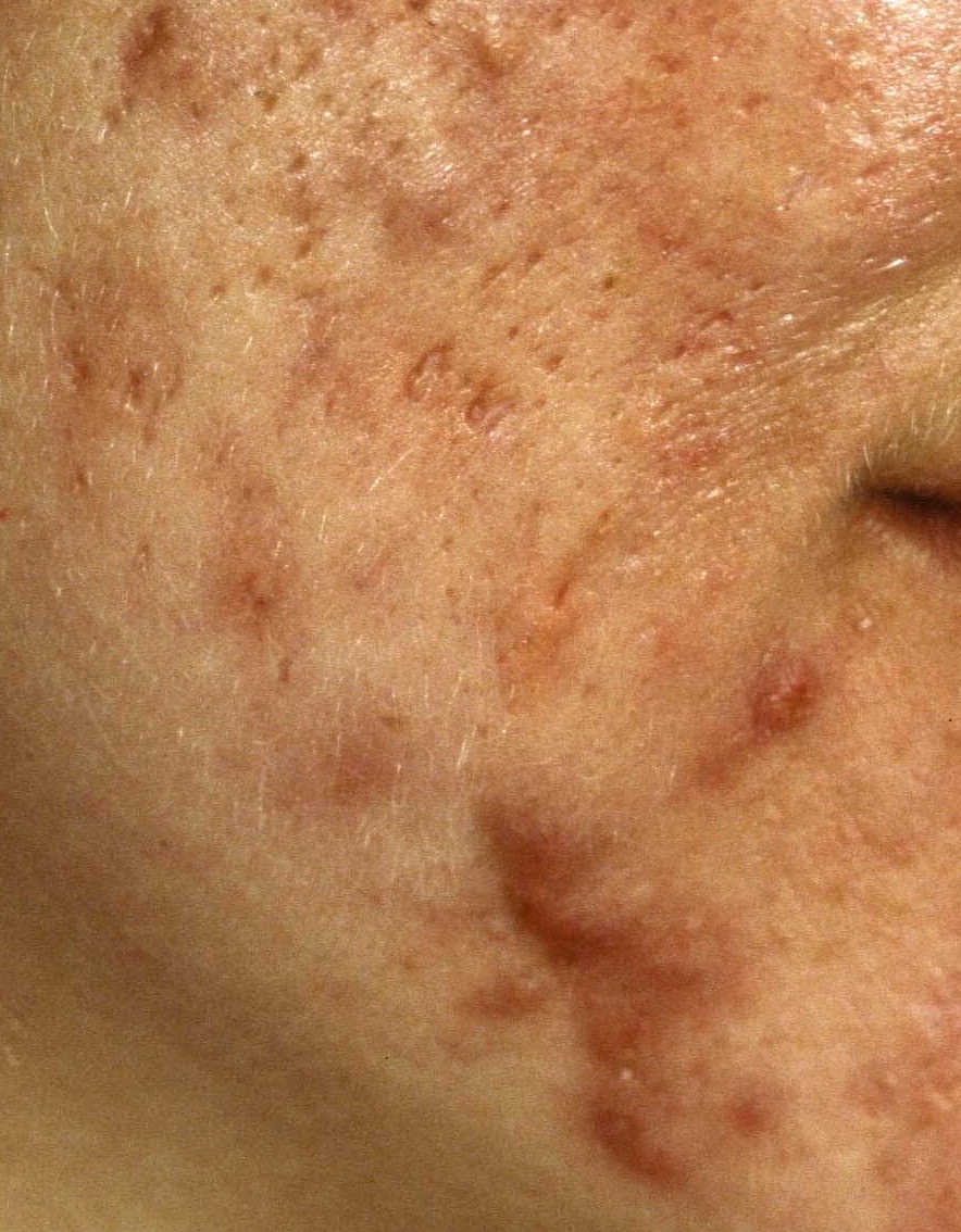 Acne.jpg